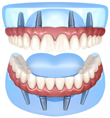 Implante dentário - desenho